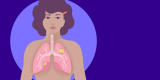 Non-Smoking Women Can Get Lung Cancer